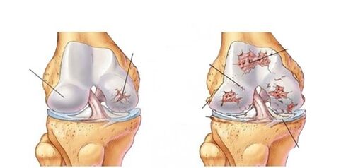 artrose deformante do joelho