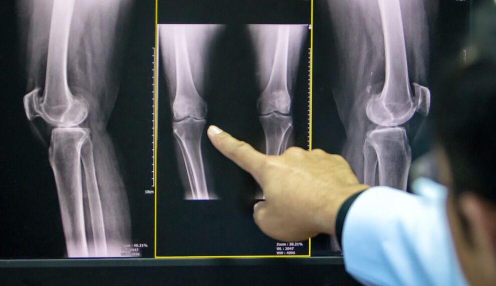 artrose do joelho raio-x