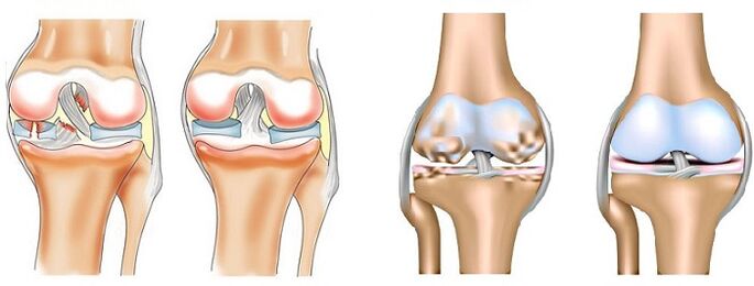 Diferença entre artrite (esquerda) e artrose (direita) das articulações