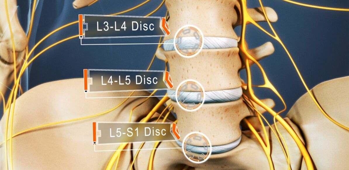 Discos da coluna lombar, que são mais frequentemente afetados na osteocondrose