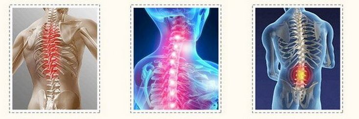 osteocondrose de coluna diferente