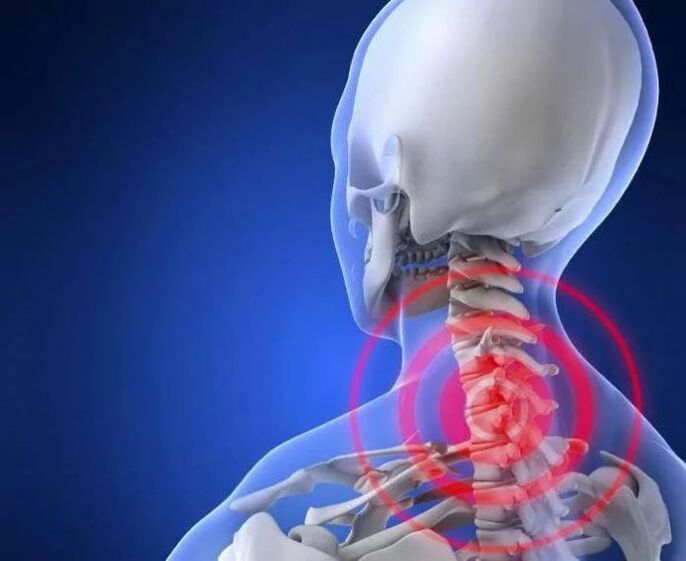 O que é osteocondrose