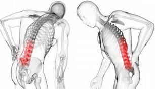 Hérnia intervertebral - complicação com osteocondrose