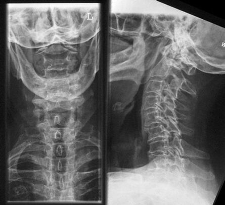Raio x cervical - Método de diagnóstico de osteocondrose