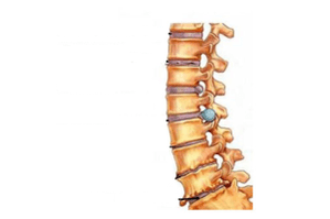 Danos à coluna com osteocondrose cervical