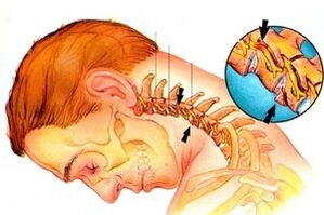 beliscando o nervo na coluna com osteocondrose cervical