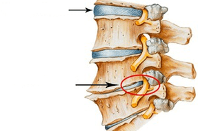 coluna normal e danificada com osteocondrose cervical