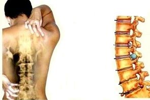 dor nas costas em diferentes estágios do desenvolvimento da osteocondrose cervical