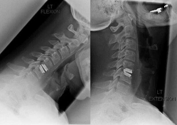 imagem da coluna após a cirurgia