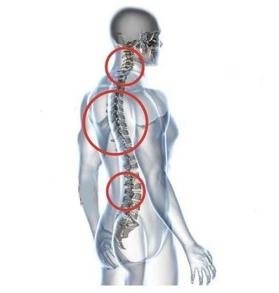 locais de osteocondrose espinhal