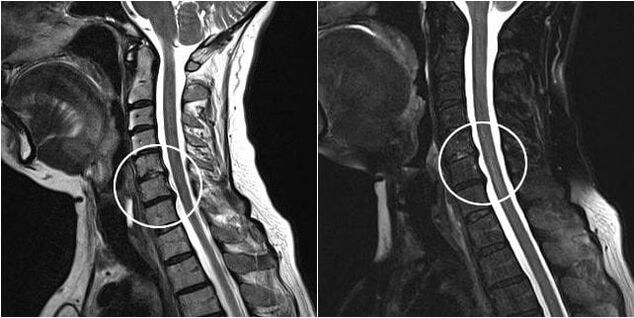 ressonância magnética da coluna cervical