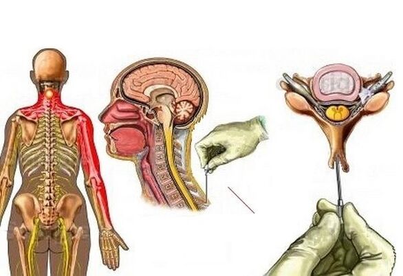 tratamento da osteocondrose cervical com acupuntura