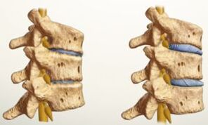 como é a osteocondrose