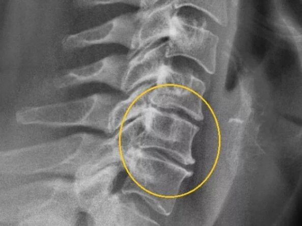 Osteocondrose da coluna cervical em radiografia